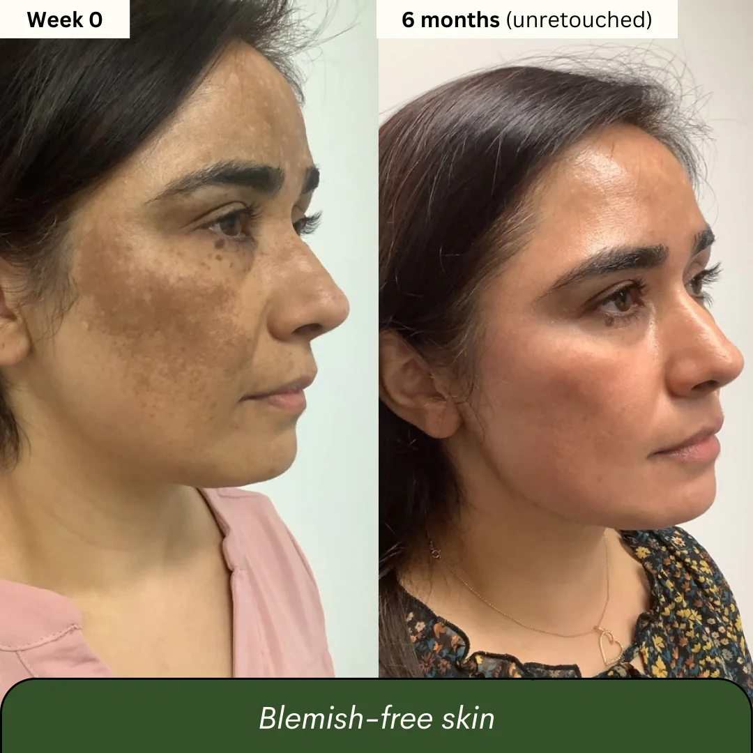 Kojic Acid 4-in-1 Brightening Soap - Unveil Your Brightest Skin. The Natural 4-in-1 Secret to Radiant Glow.